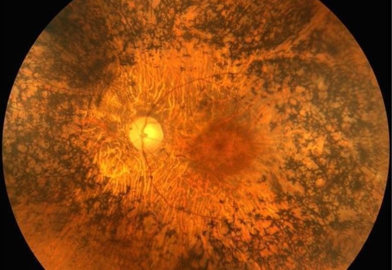 Retinite: come prevenire l'infiammazione della retina?